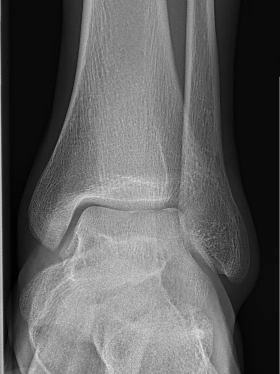 X-ray of a normal ankle joint, front view