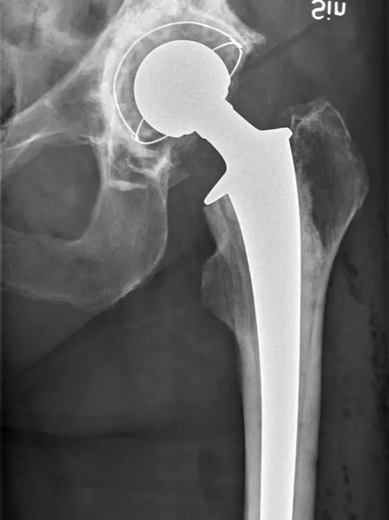 X-ray of a hip replacement, front view