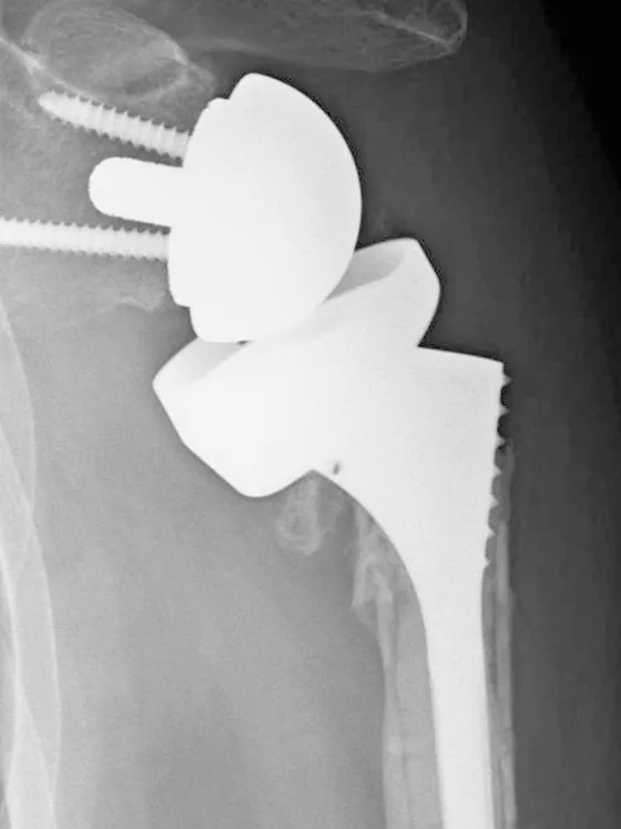 X-ray of a reverse shoulder replacement, front view